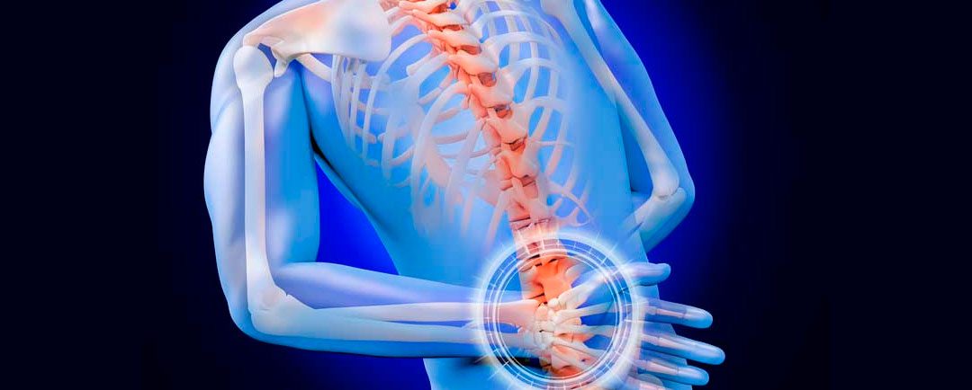 Espondilitis Anquilosante