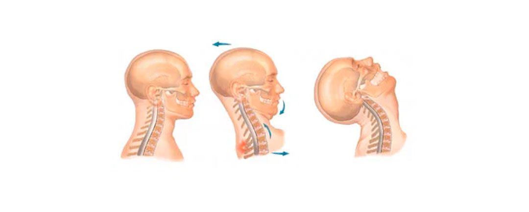 Lesión de latigazo cervical