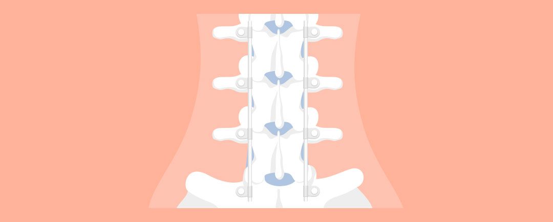 ¿Artrodesis de Columna?