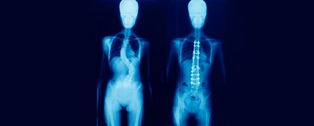 Escoliosis