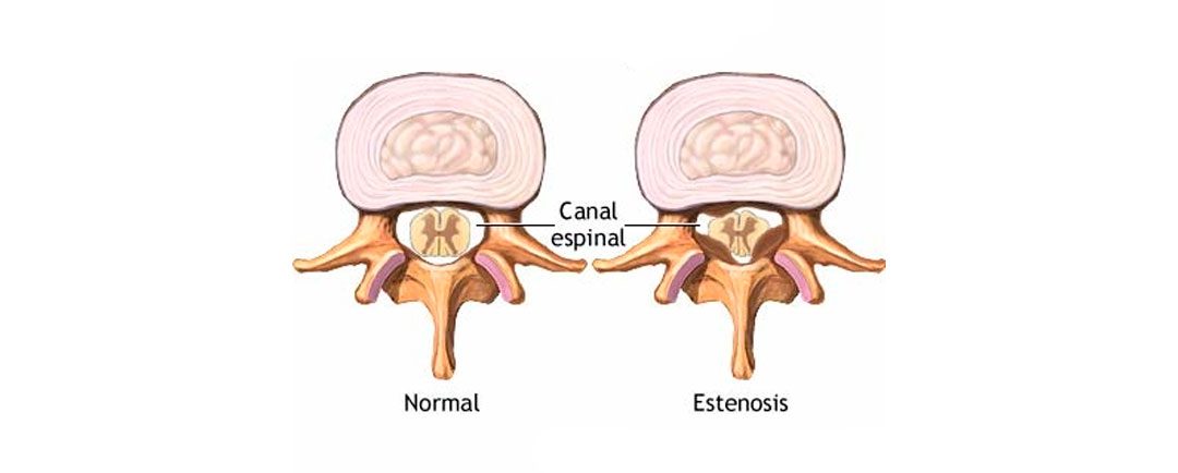 Estenosis del Canal Lumbar