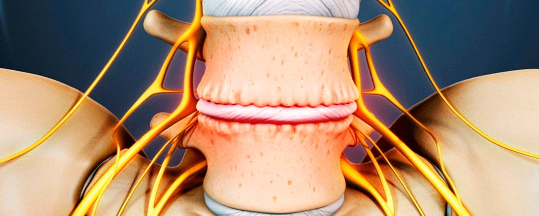 La Discopatía Degenerativa Lumbar