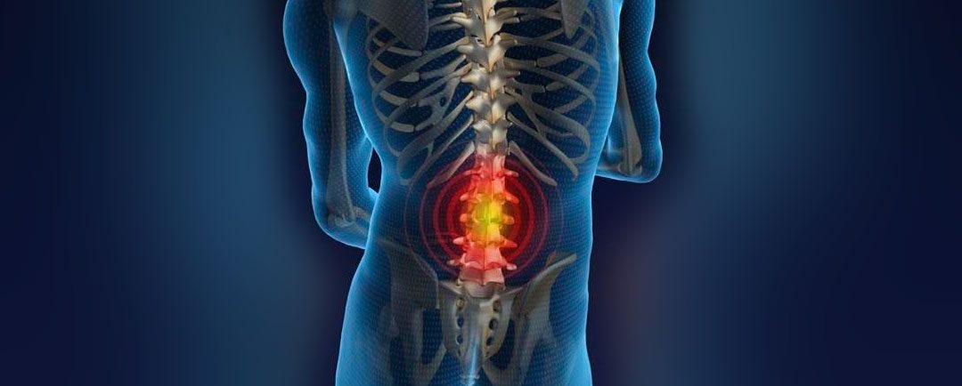 Niveles de la Hernia Discal