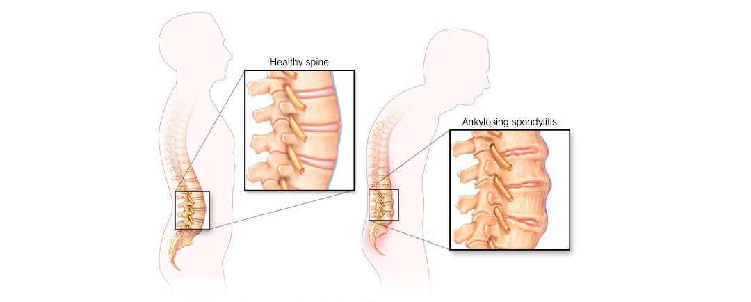 ¿Qué es la Enfermedad Espondilitis?