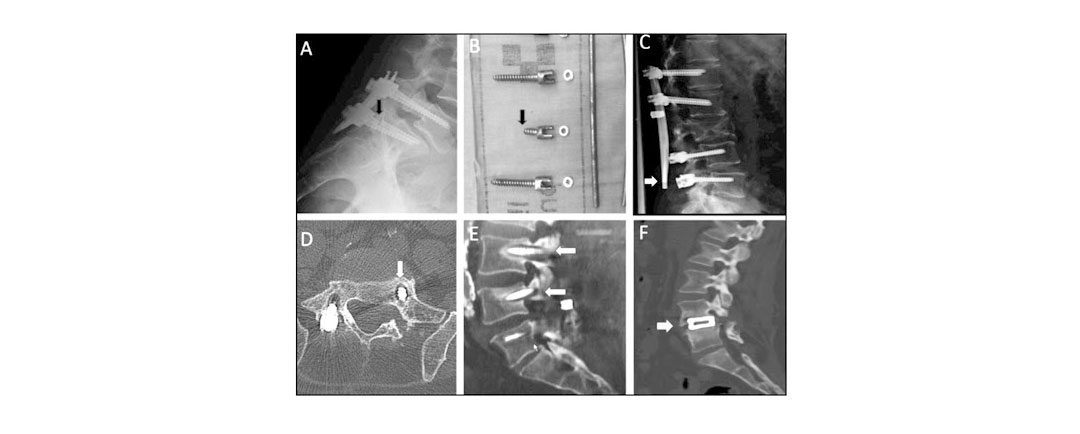 Artrodesis vertebral posterior