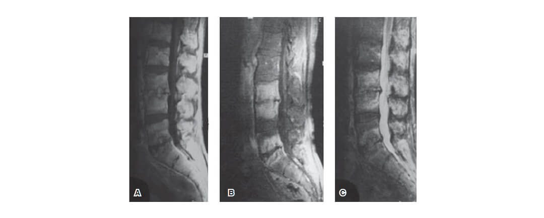 Brucellosis y lumbalgia (dolor en zona lumbar de columna)
