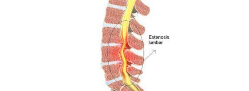 Estenosis del conducto vertebral