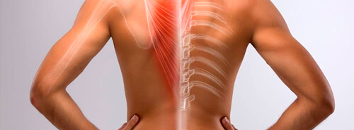 Hernia de disco cervical