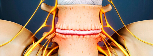 La Discopatía Degenerativa Lumbar
