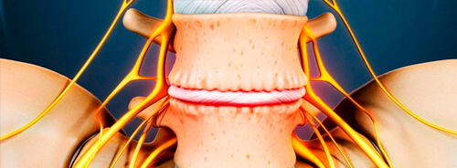 La Discopatía Degenerativa Lumbar