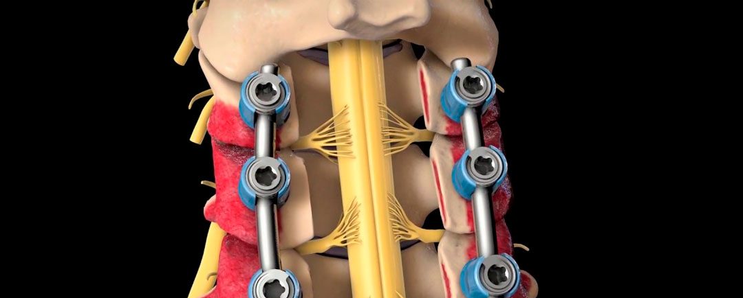 Dr. Esteban Castro - Ortopedia y traumatología Laminectomía