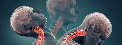 Dr. Esteban Castro - Ortopedia y traumatología Lesión de latigazo cervical Lesión de latigazo cervical