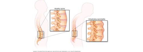 Qué es la Enfermedad Espondilitis