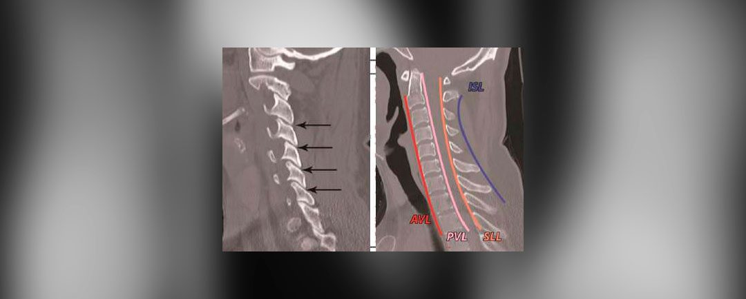 Trauma cervical subaxial