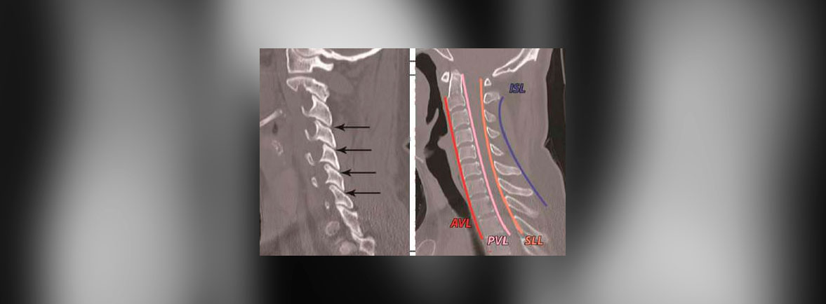 Dr. Esteban Castro - Ortopedia y traumatología Trauma cervical subaxial