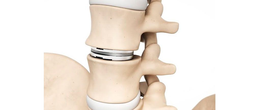 Prótesis de Columna