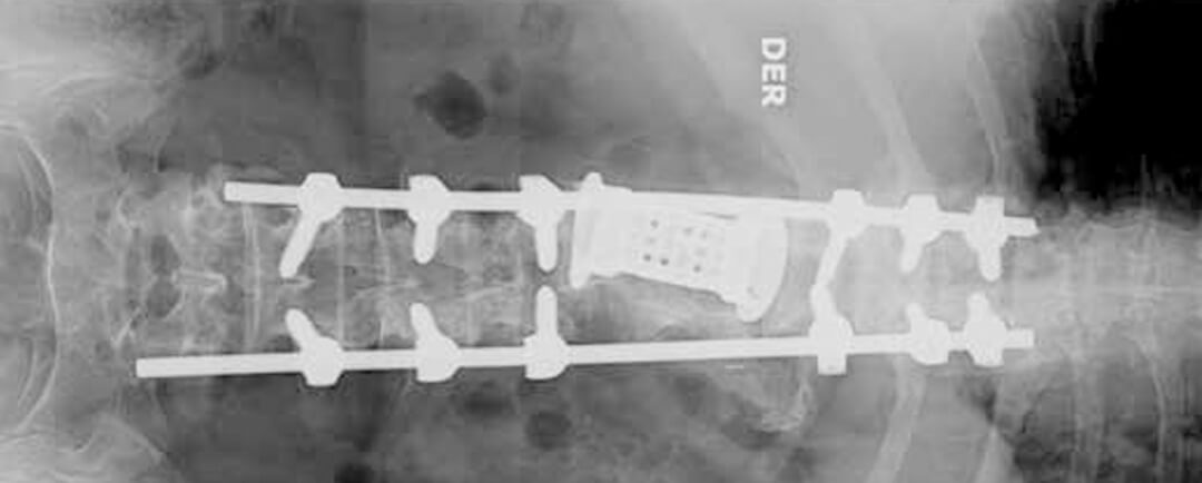Hidatidosis vertebral