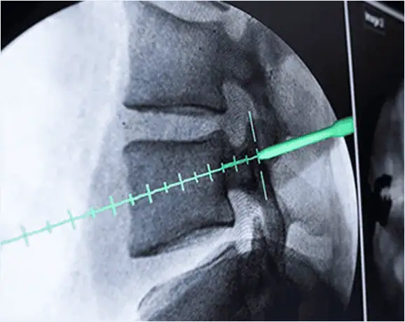 Imagen de fluoroscopia intraoperatoria para procedimiento de columna vertebral