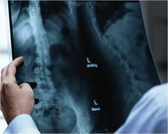 Especialista en columna evaluando radiografía de fractura vertebral en Guadalajara