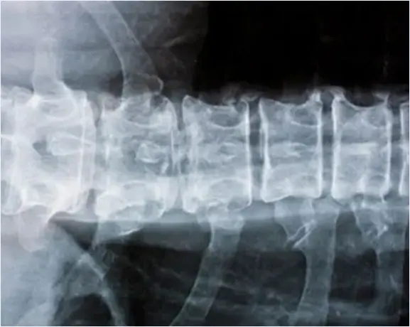 Radiografía de alineación de vértebras lumbares tras trauma vertebral