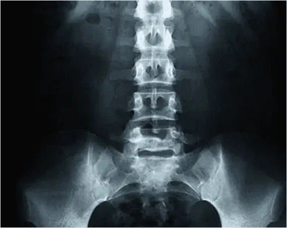 Radiografía anteroposterior de columna lumbar para detección de fractura