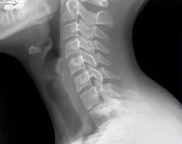 Radiografía lateral de columna cervical para valoración de trauma de cuello