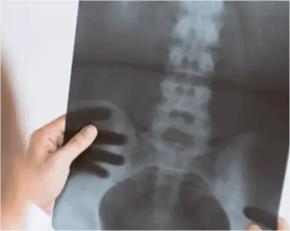 Radiografía de columna lumbosacra y pelvis para diagnóstico de lesión