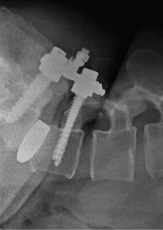 Radiografía de fijación lumbar con tornillos por fractura de columna
