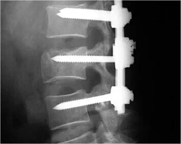 Radiografía lateral de columna lumbar con fijación de tornillos transpediculares