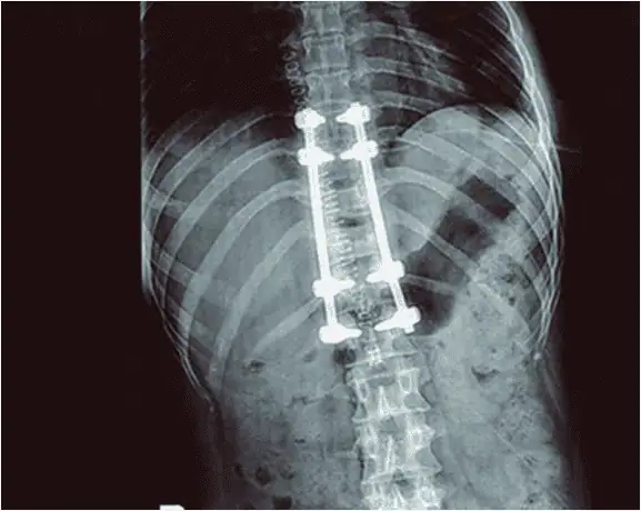Radiografía de fijación con barras y tornillos por fractura o escoliosis en columna